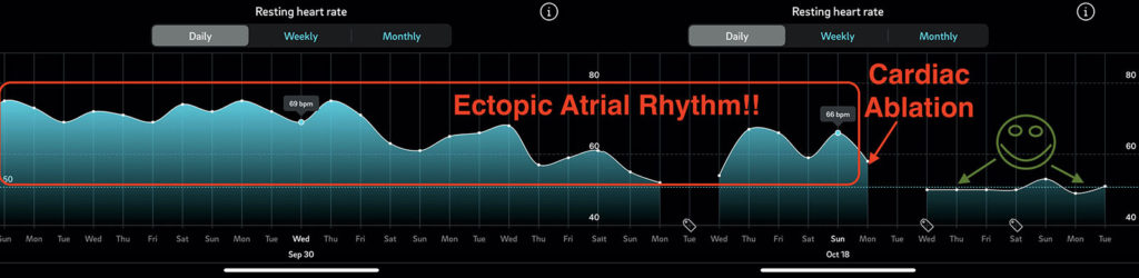 Ectopic Atrial Rhythm ALL FIXED