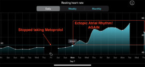 Ectopic Atrial Rhythm Stop Metoprolol