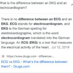 Ectopic Atrial Rhythm ECG EKG
